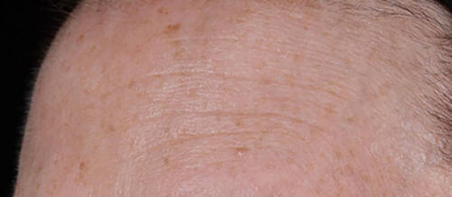 Serum Génifique Ultimate Serum 115ml 11 fine lines and wrinkles before