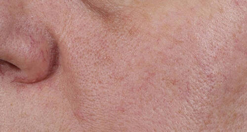 Serum Génifique Ultimate Serum 115ml 9 evenness before